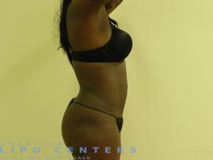 americanlipocenters_175.jpg